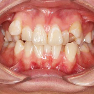 八重歯・叢生の歯科矯正治療例