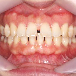 すきっ歯の歯科矯正治療例