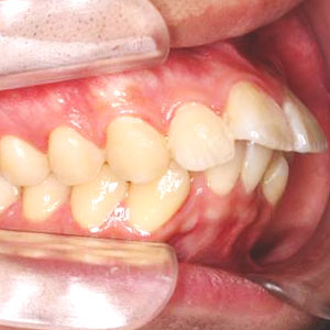 出っ歯の歯科矯正治療例