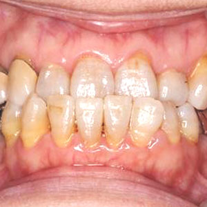 受け口の歯科矯正治療例