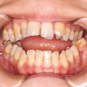 開咬の歯科矯正治療例