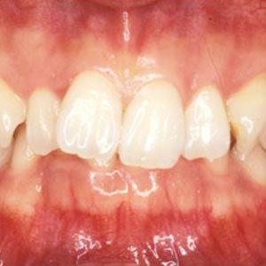 過蓋咬合の歯科矯正治療例
