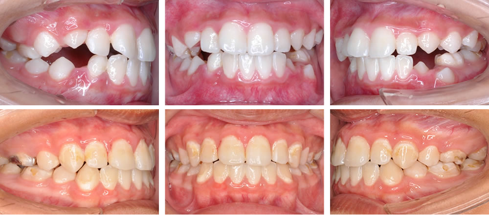 子どもの叢生の矯正治療例
