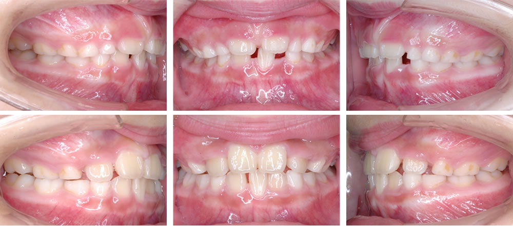 子どもの八重歯・叢生の矯正治療例