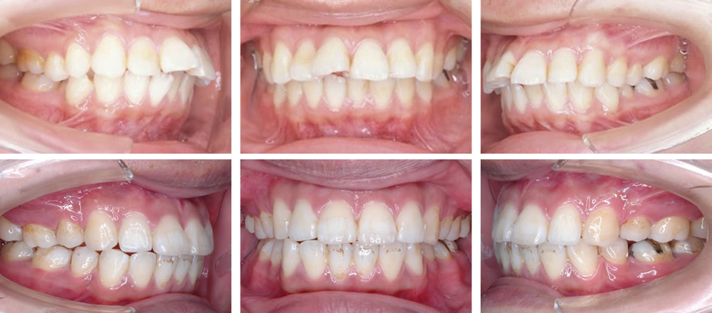出っ歯（上顎前突）の矯正治療例