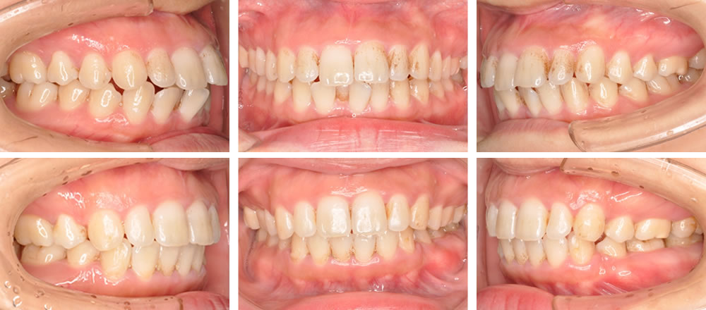 出っ歯の矯正治療例