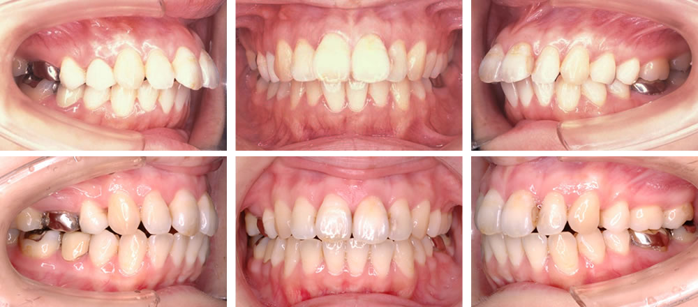 出っ歯の矯正治療例