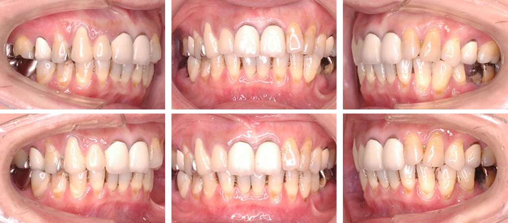部分矯正の矯正治療例