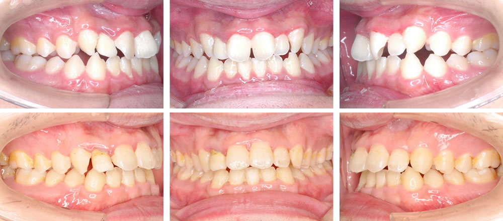 部分矯正の矯正治療例