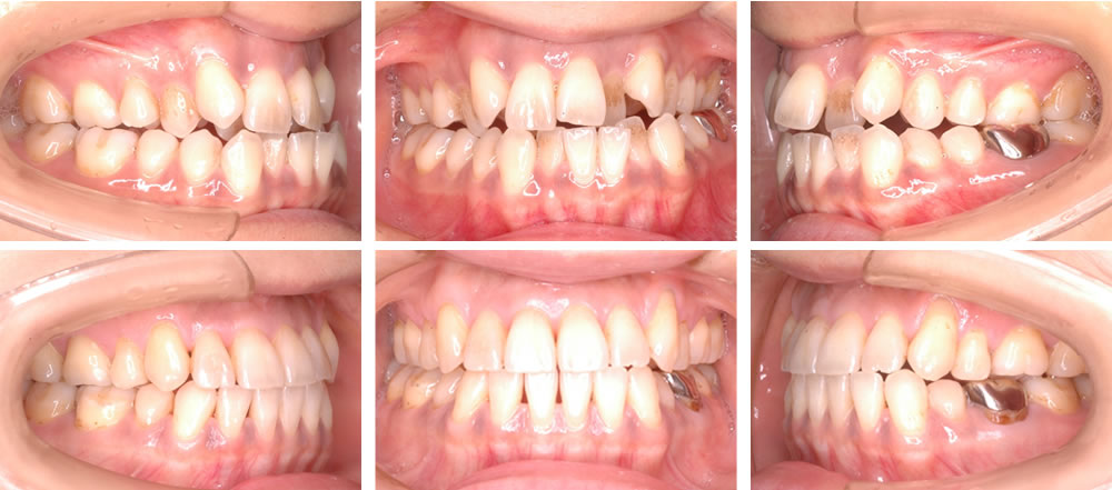 八重歯・叢生の矯正治療例