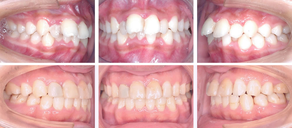 八重歯・叢生の矯正治療例