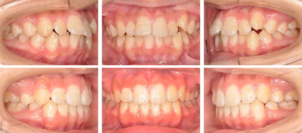八重歯・叢生の矯正治療例