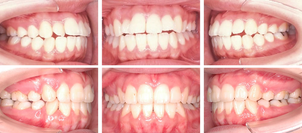 すきっ歯（空隙歯列）の矯正治療例