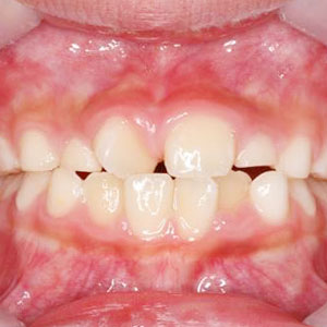 子どもの八重歯・叢生の矯正治療例