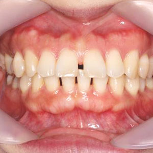 子どものすきっ歯の矯正治療例