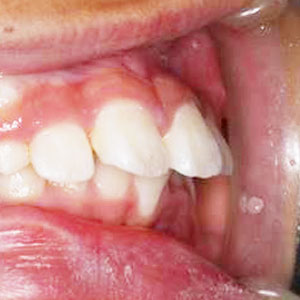 子供の出っ歯の矯正治療例