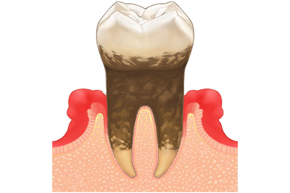 歯周病になりやすい